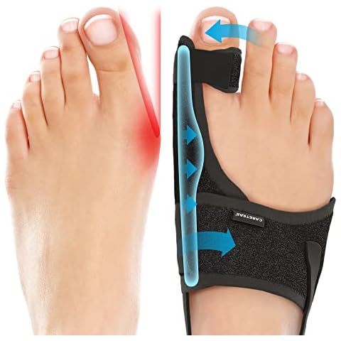 Flexible Bunion Splints